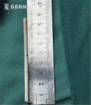 7岁男孩腹痛近1周 医生取出8厘米棒棒糖棍子