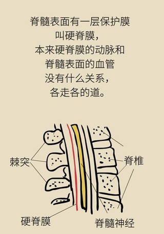 这种病很容易被误诊你了解硬脊膜动静脉瘘吗